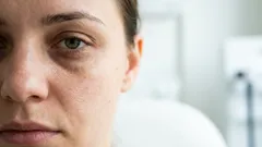 Ako sa zbaviť tmavých kruhov pod očami bez drahých krémov – 7 jednoduchých pravidiel od odborníka